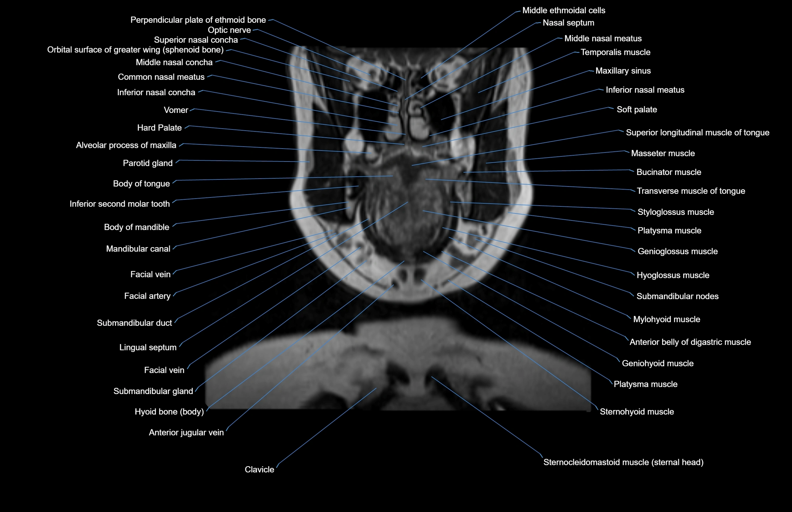 Neck coronal cross sectional MRI anatomy 3T MRI  image-img-00001-00054.webp